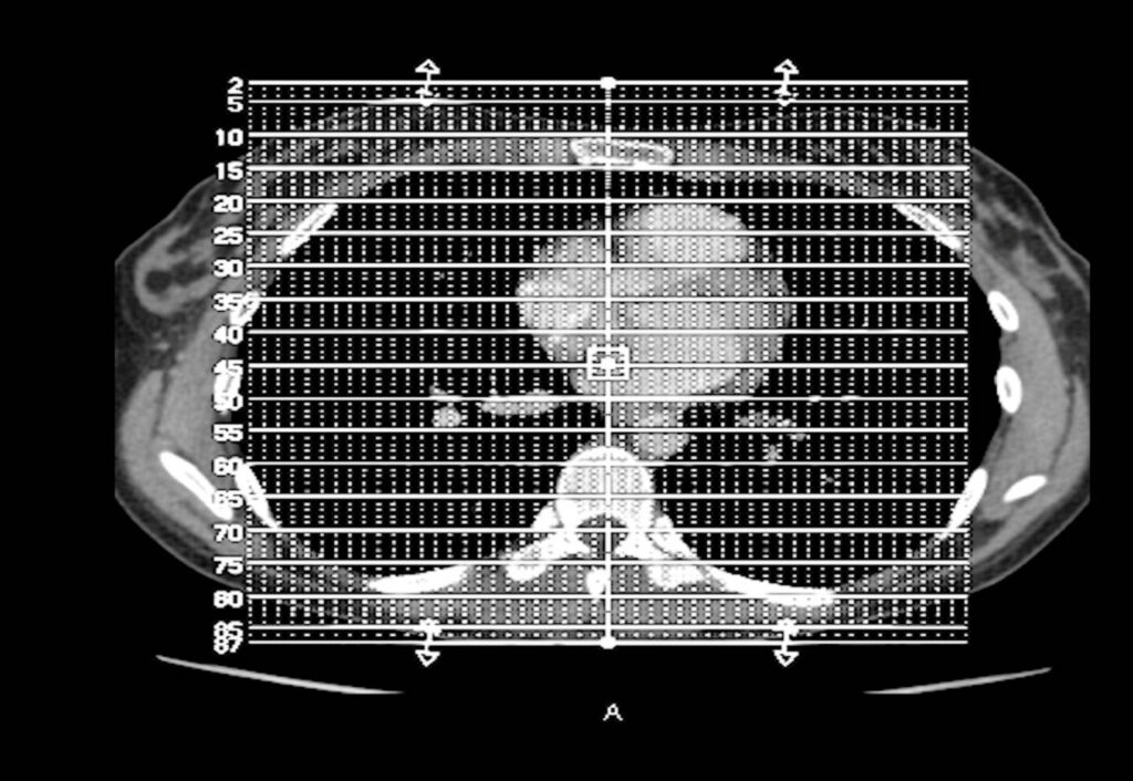 CT scan of chest with a grid overlay, showing lungs, heart, and spine in a cross-sectional view.